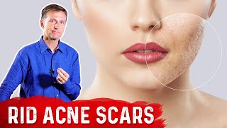 Best Way to Rid Acne Scars [upl. by Virgy]