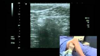 Popliteal Block Ultrasound guided  lateral approach [upl. by Drusie]