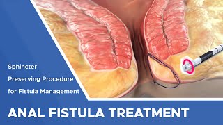 Closure of Fistula Tract with Laser [upl. by Benge]