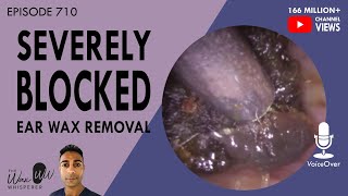 710  Severely Blocked Ear Wax Removal [upl. by Haisi]