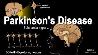 Parkinsons Disease Animation [upl. by Anatollo617]