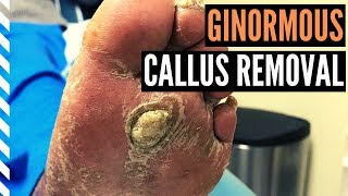 Ginormous Callus Removal [upl. by Ardnossak]