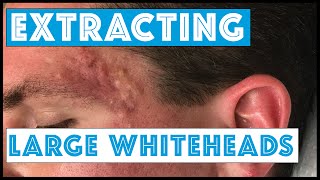 Acne Vulgaris and Extracting large Whiteheads  Part 1 [upl. by Assil]