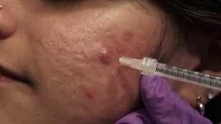 Watch amp Learn Intralesional injections [upl. by Cohla443]