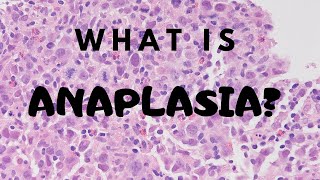 What is Anaplasia  Pathology mini tutorial [upl. by Ailecnarf]