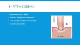 Pitting Edema Grading Scale 4 Levels [upl. by Rosemarie]