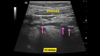 Submandibular duct stones [upl. by Adnirual]