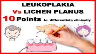 leukoplakia vs lichen planus  10 points to differentiate clinically [upl. by Jerome383]