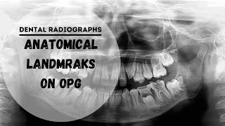 Dental panoramic radiographs  OPG  DPT Anatomical Landmarks [upl. by Namzed]