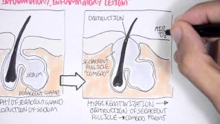 Acne Pathophsyiology [upl. by Valery]