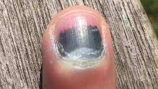 Fingernail Time Lapse 4 Month Recovery [upl. by Niwred94]