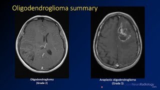 Imaging brain tumors  3  Oligodendrogliomas [upl. by Ciprian418]