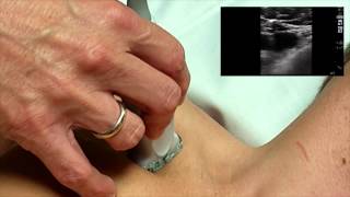 Ultrasound Guided Subclavian Line [upl. by Llerral45]