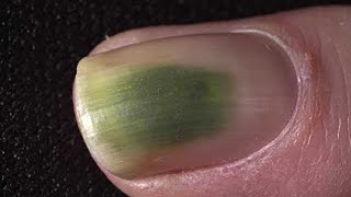 Green Toenail Fungus Cure Home Treatment Guide [upl. by Nwahser526]