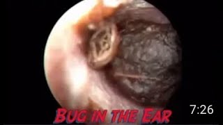 Insect inside the ear [upl. by Aninaj]