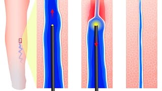 Comment se soignent les varices [upl. by Amak]