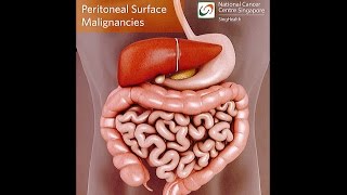 All About Peritoneal Tumours Causes Symptoms Diagnosis and Treatment [upl. by Ainesej400]