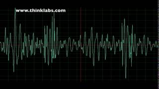 Atrial Septal Defect [upl. by Ahsied]