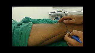 Lateral approach popliteal sciatic block  Peripheral nerve stimulator PNS [upl. by Yerfdog]