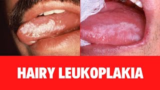 WHAT IS HAIRY LEUKOPLAKIA Oral Hairy Leukoplakia Symptoms Causes Diagnosis Treatment [upl. by Arin618]