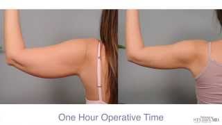 Get Firm Sculpted Arms With Smartlipo™  Dr Sterry Explains [upl. by Cordi97]