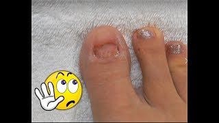 No TOENAILS  Make Some  Acrylic Glitter Toesnails  Using Dual Forms [upl. by Holt]