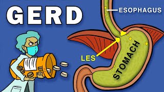 Gastroesophageal Reflux Disease GERD [upl. by Aciraj]