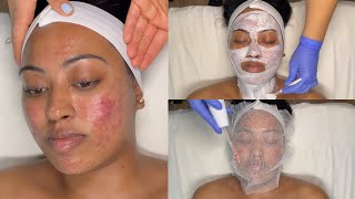 CYSTIC ACNE TREATMENT  WALKIN FACIAL FOR GRADE 3 AND 4 ACNE WITH PRO TIPS  LICENSED ESTHETICIAN [upl. by Nreval]