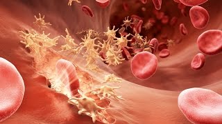 Understanding Hemophilia [upl. by Robbert9]