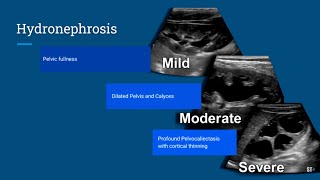 Hydronephrosis Ultrasound [upl. by Affrica]