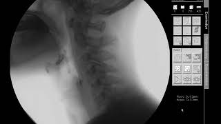 Swallow Study  Solid TextureCracker  Modified Barium Swallow Study MBSS Lateral View HD [upl. by Minetta994]