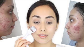 Derma Roller for Acne Scars  How I Healed My Acne Scars [upl. by Aneehsak]