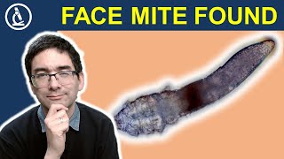 Demodex FACE MITE under the microscope [upl. by Ahtenak]