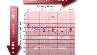 How to Read an Audiogram [upl. by Etac]