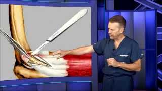 Tennis Elbow Surgery [upl. by Ylenats427]