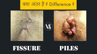 Piles vs Fissure  Difference [upl. by Spanos]