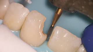 Teeth Bonding  Front tooth filling EXPLAINED [upl. by Jacques]