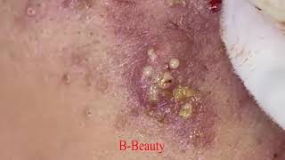 Pimple Removal and Acnes Treatment  BBeauty 07 [upl. by Solracsiul648]