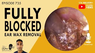 735  Fully Blocked Ear Wax Removal [upl. by Caresse119]