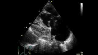 PULMONARY EMBOLISM  EMBOLIE PULMONAIRE  ECHOCARDIOGRAPHY cardiac ultrasound [upl. by Atal]