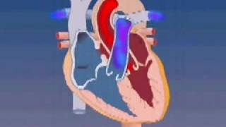 Atrial Septal Defect Repair at SSM Heart Institute [upl. by Adniled]