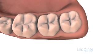 Pit and fissure sealants  Lapointe dental centres [upl. by Trust]