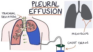 Understanding Pleural Effusions [upl. by Cate]