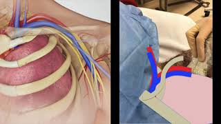 Ultrasound Guided Subclavian Vein Central Line Placement [upl. by Robbin]