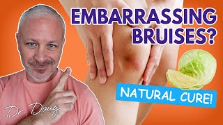 BRUISES How to get rid of them Fast  Dr Doug Willen [upl. by Herahab41]