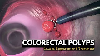 Irritable Bowel Syndrome IBS Causes Symptoms Bristol Stool Chart Types and Treatment [upl. by Artemed]