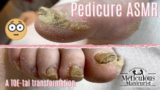 👣Pedicure ASMR on Extremely Calloused Feet👣 [upl. by Ees]