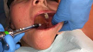 Inferior Alveolar and Lingual Nerve Blocks [upl. by Lorant]