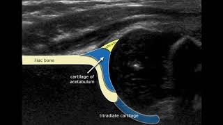 Congenital Hipdysplasia  Ultrasound Anatomy [upl. by Yrelle670]