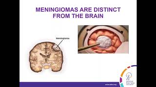 WEBINAR Treatment Strategies for Meningioma [upl. by Littman]